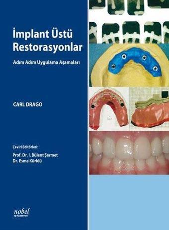 İmplant Üstü Restorasyonlar - Kolektif  - Nobel Tıp Kitabevleri