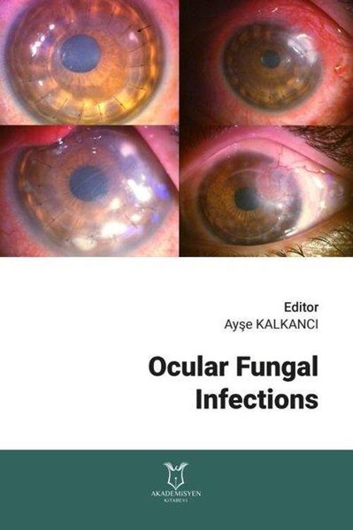 Ocular Fungal Infections