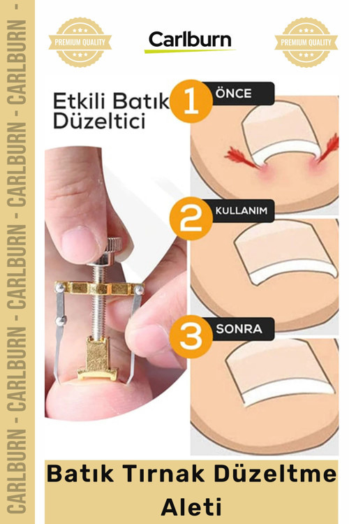 Özel Üretim Ayak Tırnağı Ağrısı Giderici Düzeltici Evde Güvenli Kolay Bakım Batık Tırnak