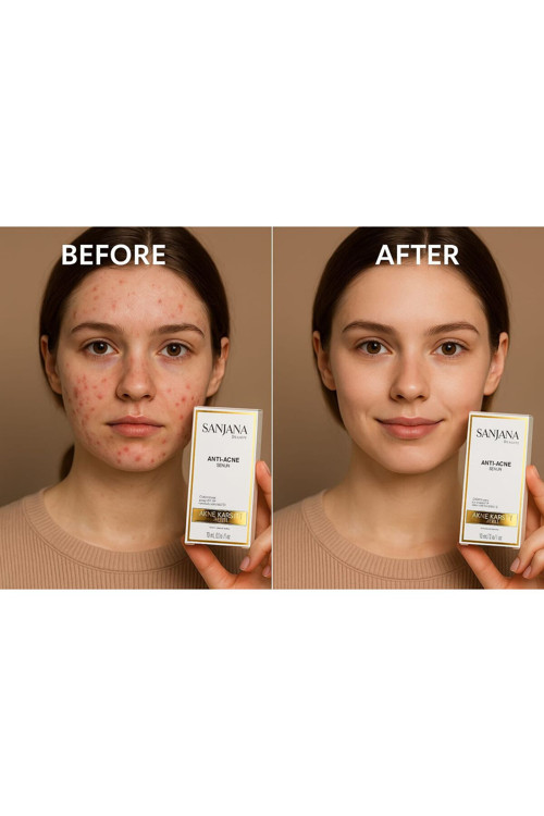 Beauty Anti-Acne Serum 10 ml | Akne Karşıtı, Kurutucu, Cilt Arındırıcı Serum