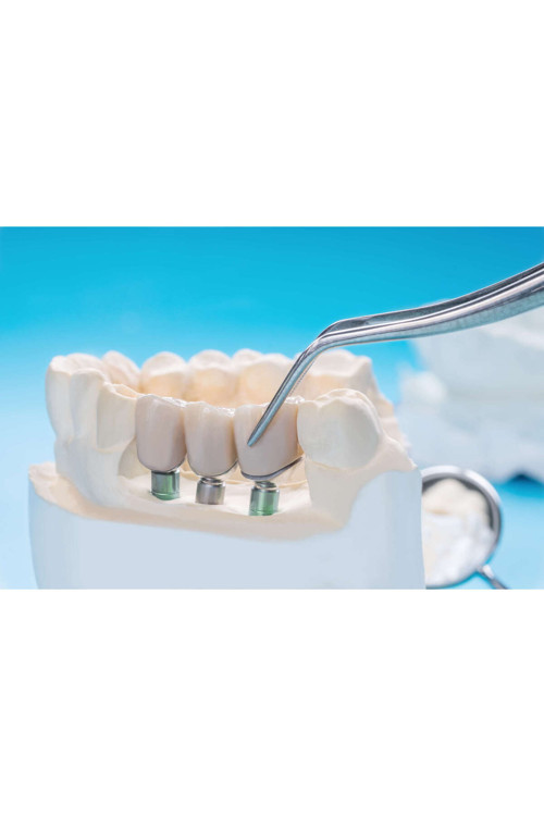 Dentist-Bridge-İmplant Kanvas Tablo