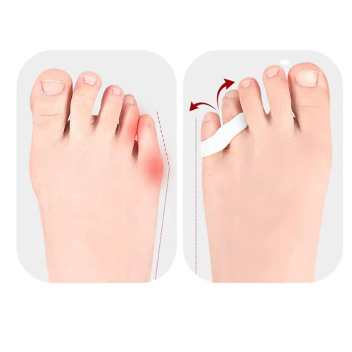 Ayak Serçe Parmak Duruş Düzeltİci, Sürtünme ve Yana Batmayı Engelleyici, Silikon Bunyon Aparat, Yastıklama, Unisex, Yan Parmağa Ğeçmeli/Geçmesiz Seçenekli (1 Çift) (Yan Parmak GEÇMELİ)