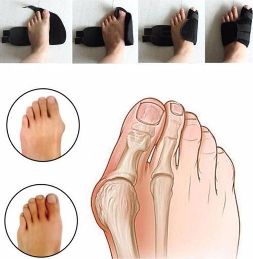 Medikal Halluks Valgus Gece Ateli Ayak Baş Parmak Bunyon Koruyucu 1 Çift (SAĞ VE SOL)(Gece Ateli EX-89)
