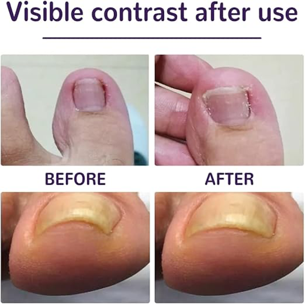 Ayak Tırnağı Düzeltme Bandı 50 Adet - Image 1