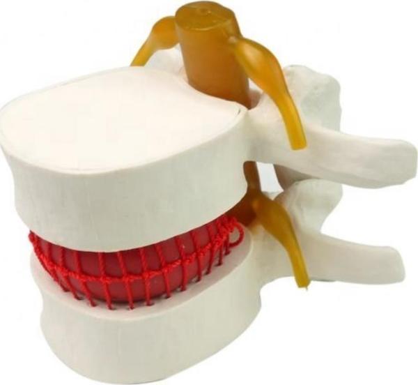 Disk Hernisi Fıtık Maketi Model 2 - Image 1