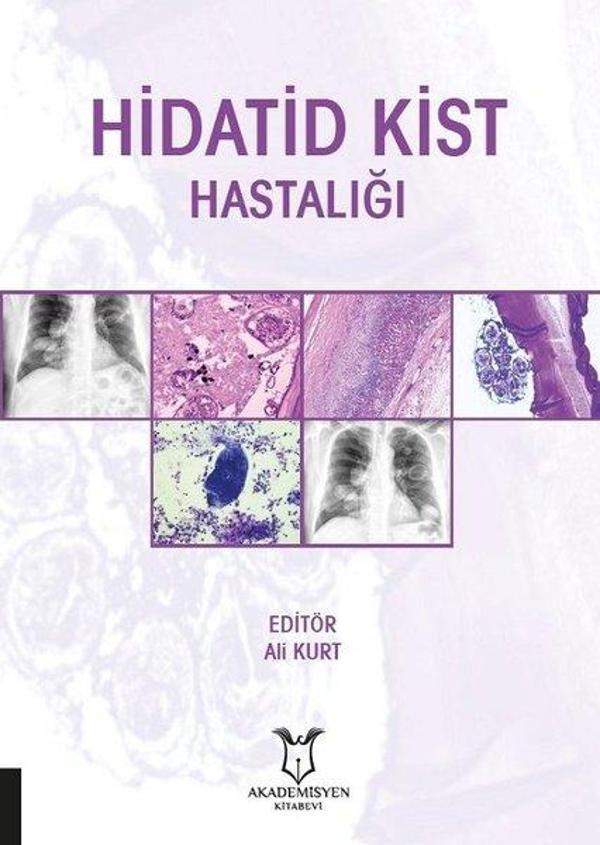 Hidatid Kist Hastalığı - Akademisyen Kitabevi - Image 1